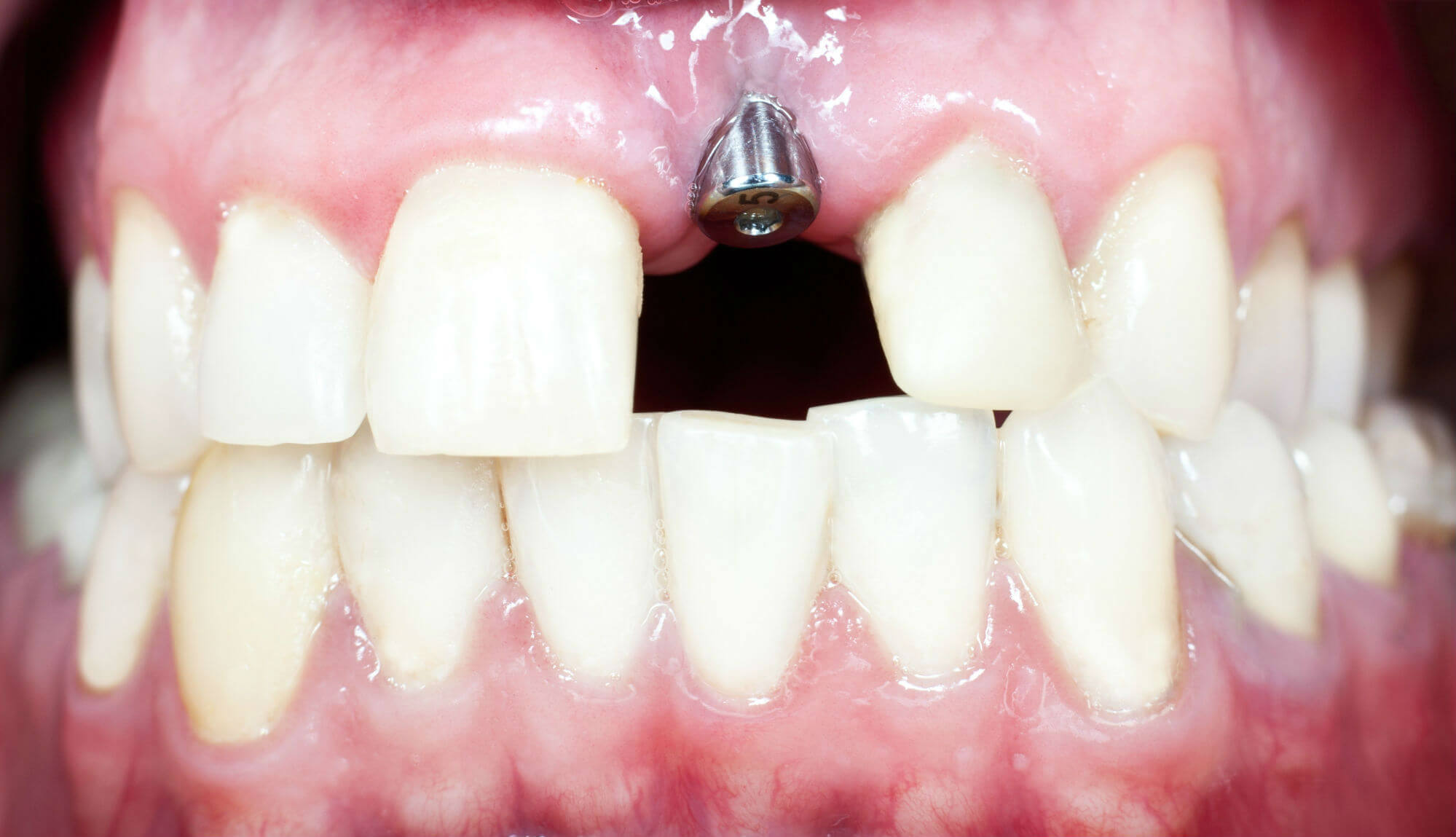 Имплантация зубов в зоне улыбки